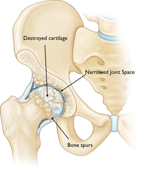 A hip with osteoarthritis.