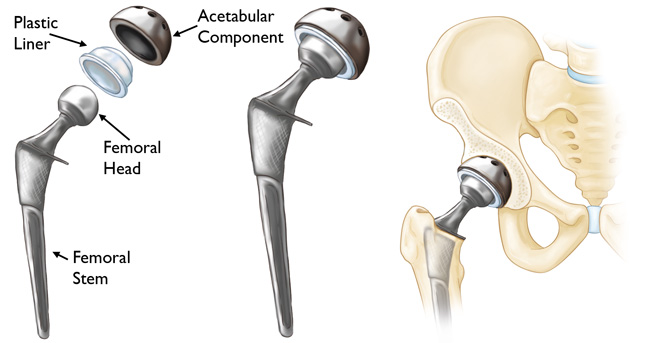 (Left) The individual components of a total hip replacement. (Center) The components merged into an implant. (Right) The implant as it fits into the hip.