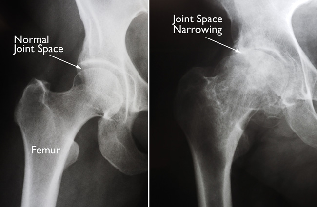 (Left) In this x-ray of a normal hip, the space between the ball and socket indicates healthy cartilage. (Right) This x-ray of an arthritic hip shows severe loss of joint space.