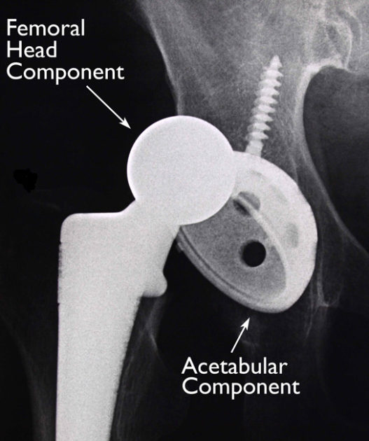 Hip implant dislocation.