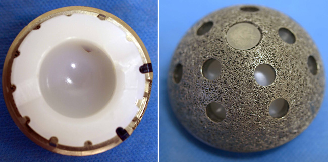(Left) The acetabular component shows the plastic (polyethylene) liner inside the metal shell. (Right) The porous surface of this acetabular component allows for bone ingrowth. The holes around the cup are used if screws are needed to hold the cup in place.