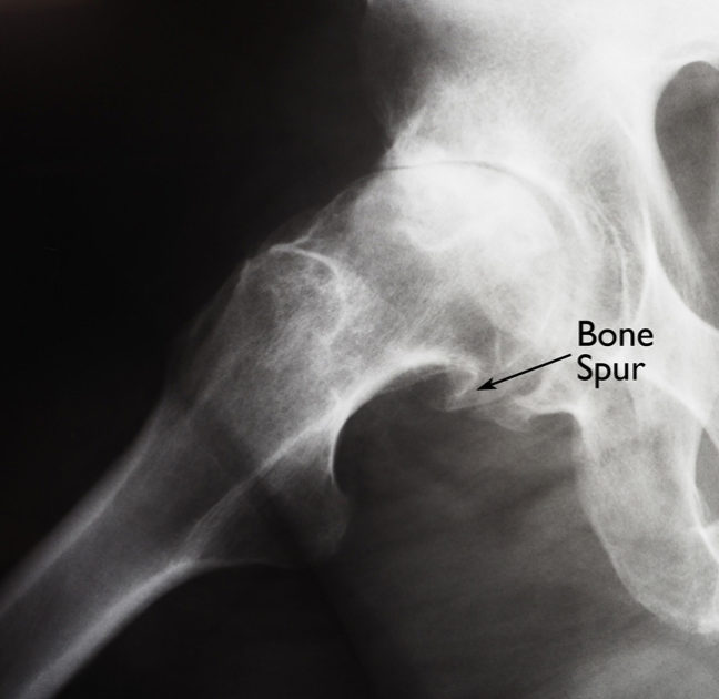 This x-ray shows a large bone spur that has developed on the ball of an arthritic hip.